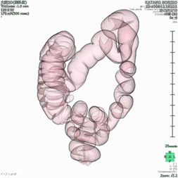 大腸CT検査画像