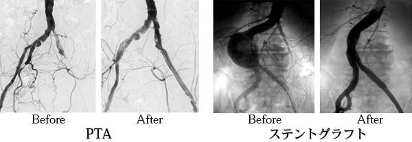 血管撮影検査 術前、術後
