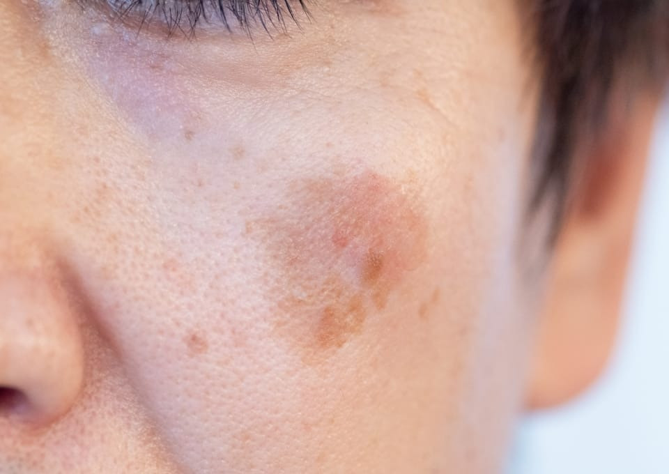 第7回　しみって治るの？いくらかかる？（形成外科　馬本 医師）