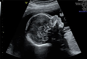 胎児精密超音波検査画像1