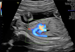 胎児精密超音波検査画像2