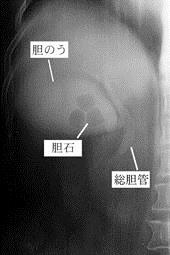 静脈的胆道造影（Drip Infusion Cholangigraphy ：DIC）